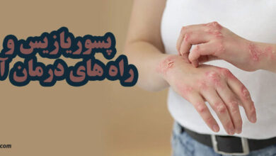 پسوریازیس