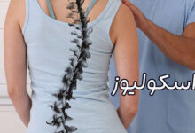 اسکولیوز