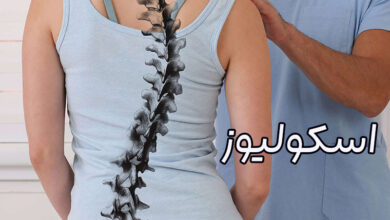اسکولیوز