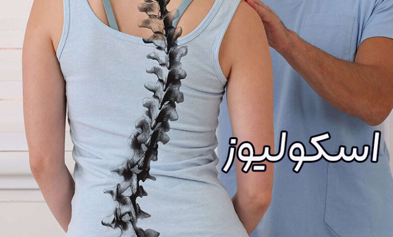 اسکولیوز