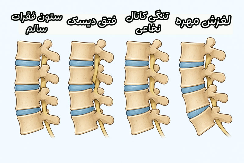 جراحی بسته ستون فقرات