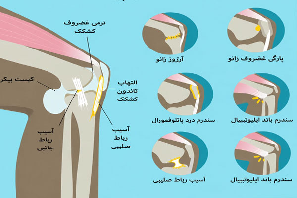 تاثیر چاقی بر آرتروز