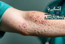 پسوریازیس چیست؟