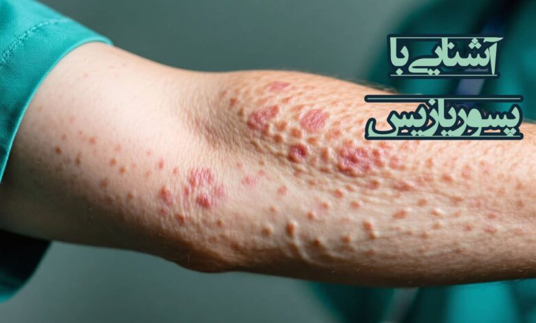 پسوریازیس چیست؟