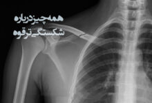 شکستگی ترقوه