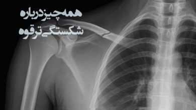 شکستگی ترقوه
