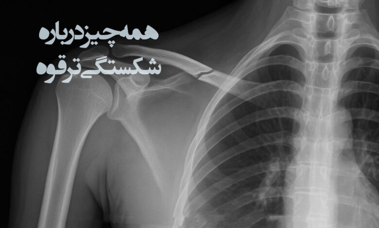 شکستگی ترقوه