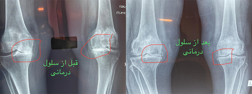 سلول بنیادی درمان ارتروز زانو
