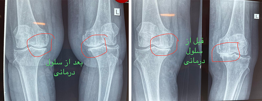 سلول بنیادی زانو