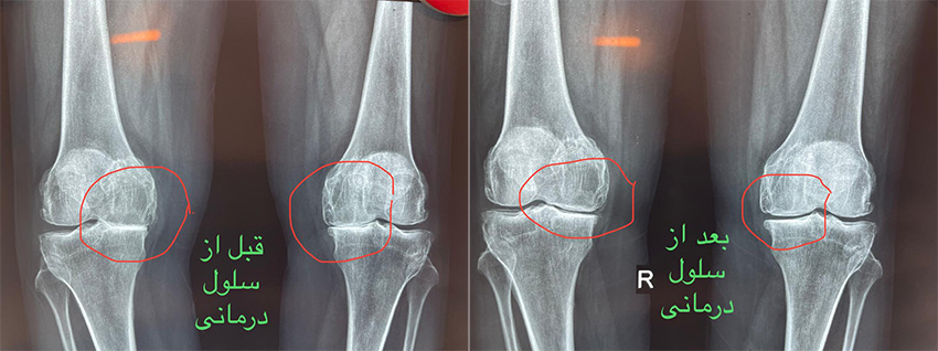 سلول درمانی زانو قبل و بعد