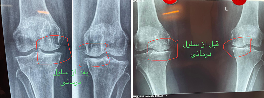 درمان ارتروز زانو