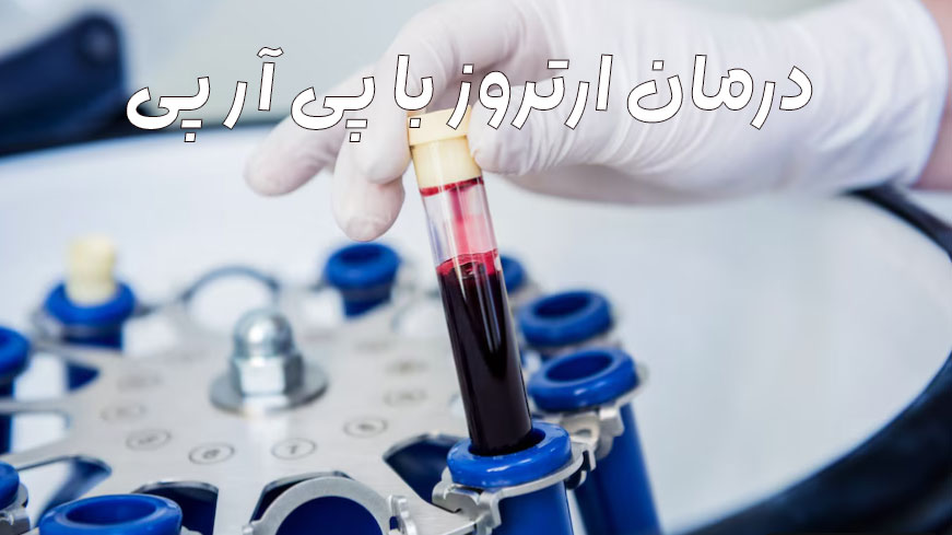 درمان-درد-زانو-با-پی-آر-پی