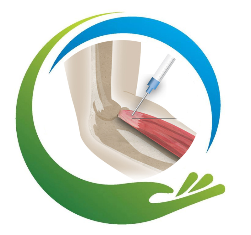 سلول-درمانی-آرنج-و-مچ-دست